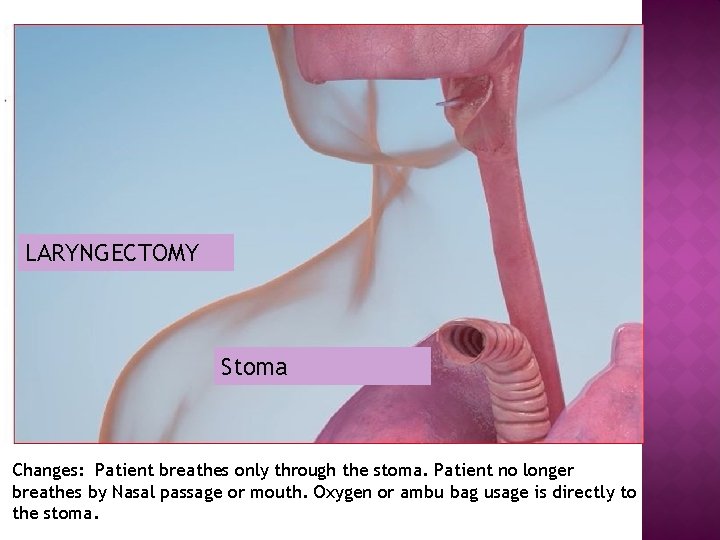 LARYNGECTOMY Stoma Changes: Patient breathes only through the stoma. Patient no longer breathes by