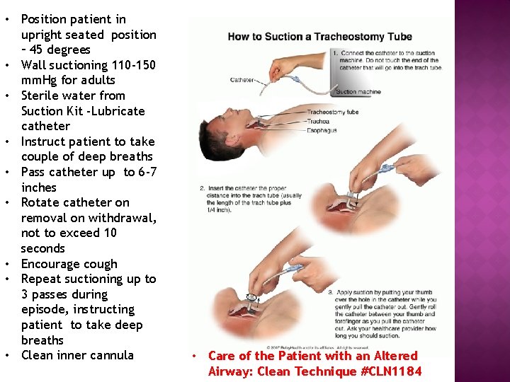  • Position patient in upright seated position – 45 degrees • Wall suctioning