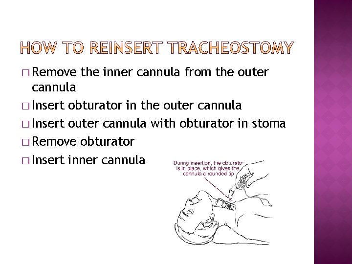 � Remove the inner cannula from the outer cannula � Insert obturator in the