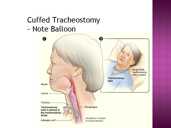 Cuffed Tracheostomy – Note Balloon 