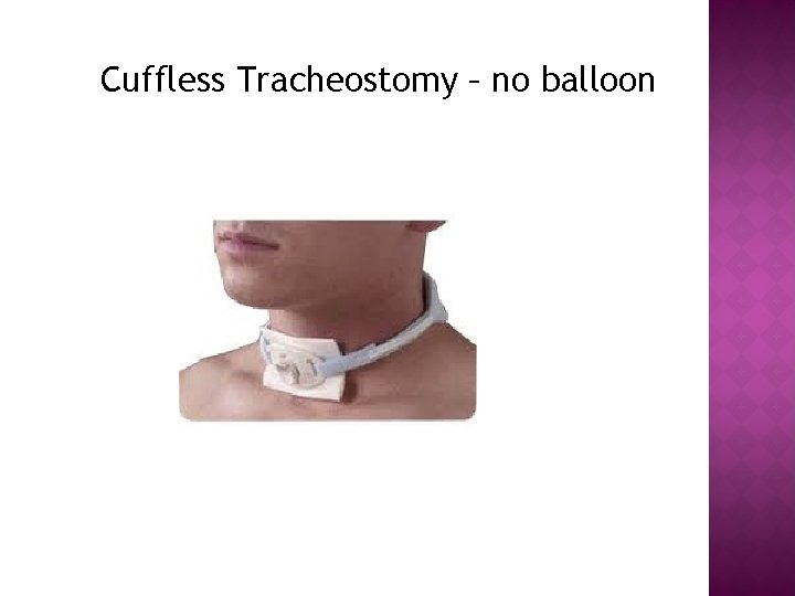 Cuffless Tracheostomy – no balloon 