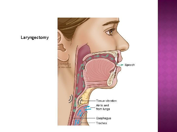 Laryngectomy 