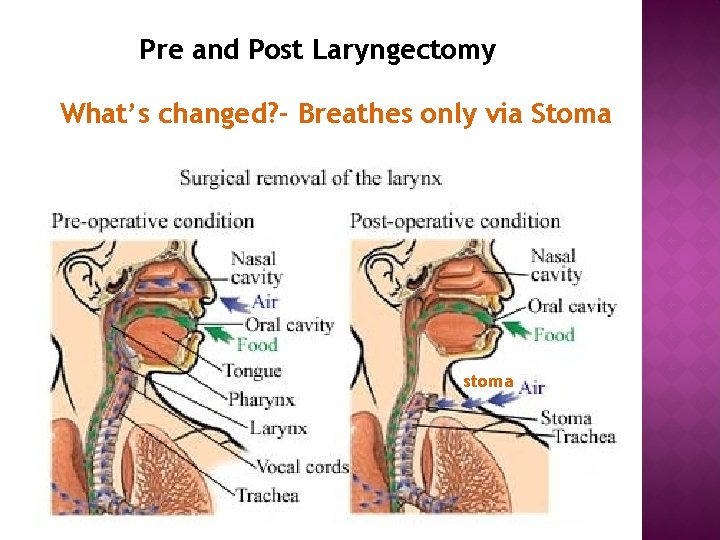 Pre and Post Laryngectomy What’s changed? - Breathes only via Stoma stoma 