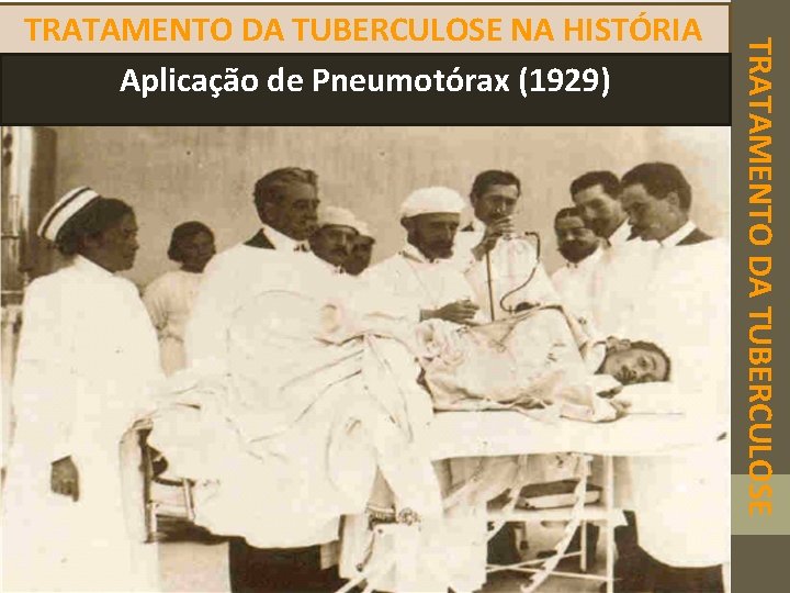 TRATAMENTO DA TUBERCULOSE NA HISTÓRIA Aplicação de Pneumotórax (1929) 