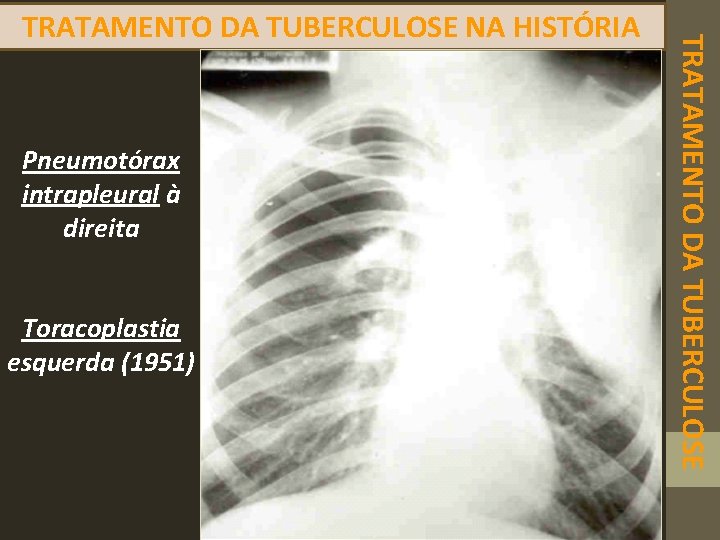 Pneumotórax intrapleural à direita Toracoplastia esquerda (1951) TRATAMENTO DA TUBERCULOSE NA HISTÓRIA 