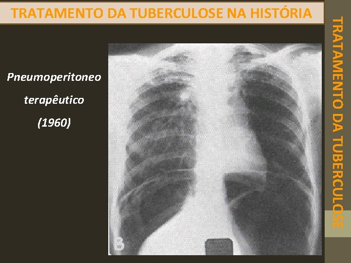 Pneumoperitoneo terapêutico (1960) TRATAMENTO DA TUBERCULOSE NA HISTÓRIA 