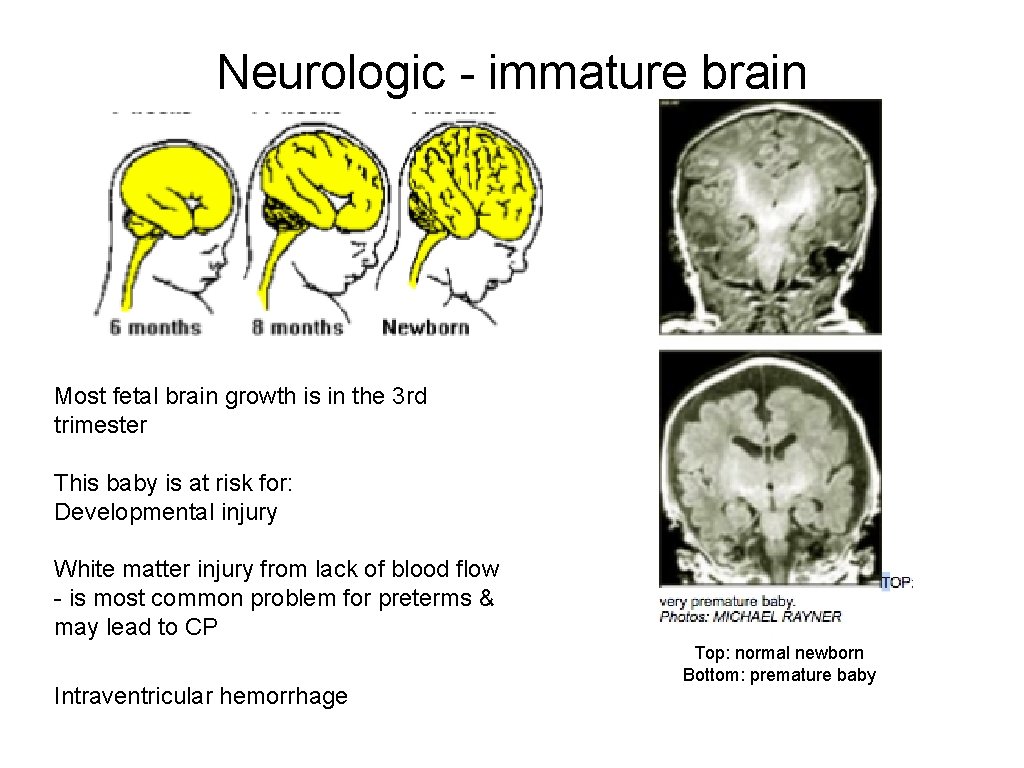 Neurologic - immature brain Most fetal brain growth is in the 3 rd trimester