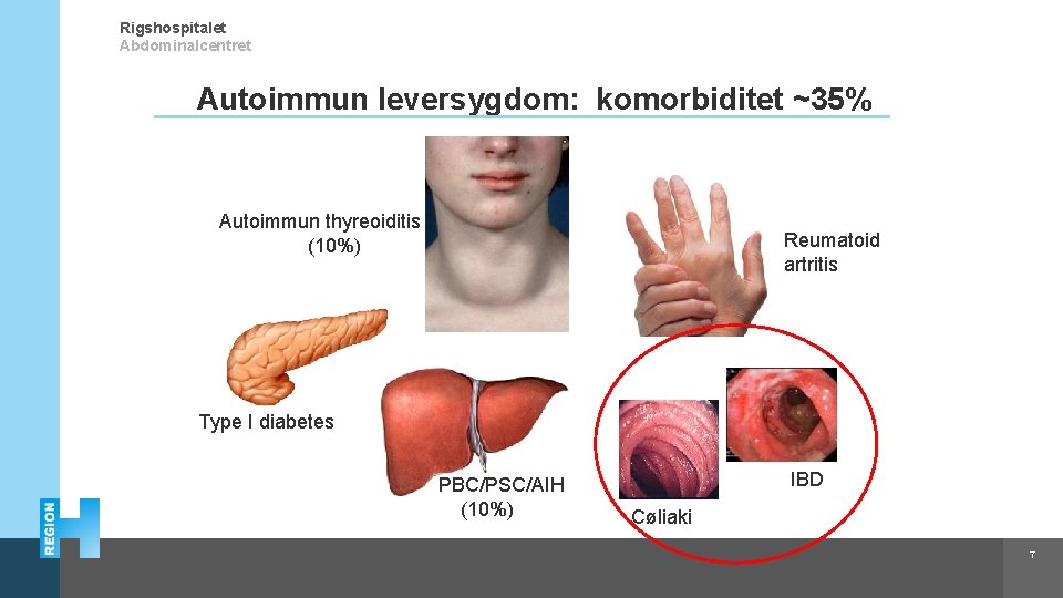 Rigshospitalet Abdominalcentret Autoimmun leversygdom: komorbiditet ~35% Autoimmun thyreoiditis (10%) Reumatoid artritis Type I diabetes