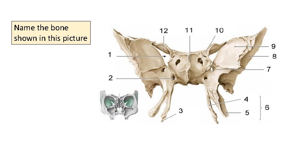 Name the bone shown in this picture 