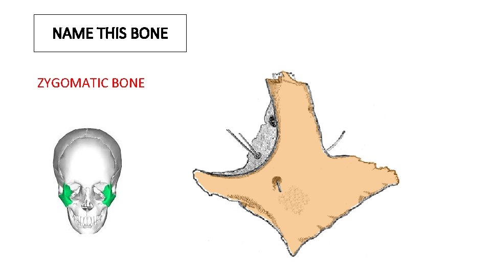 NAME THIS BONE ZYGOMATIC BONE 