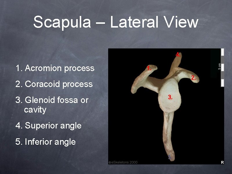 Scapula – Lateral View 4. 1. Acromion process 1. 2. Coracoid process 3. Glenoid