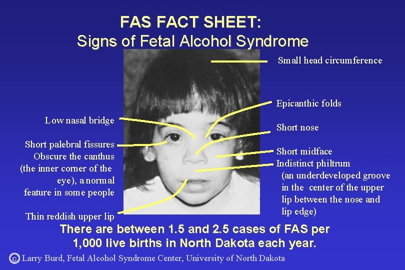 FAS FACT SHEET: Signs of Fetal Alcohol Syndrome Small head circumference Epicanthic folds Low