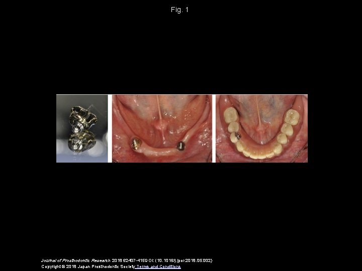 Fig. 1 Journal of Prosthodontic Research 2018 62407 -415 DOI: (10. 1016/j. jpor. 2018.