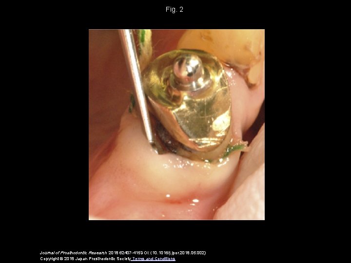 Fig. 2 Journal of Prosthodontic Research 2018 62407 -415 DOI: (10. 1016/j. jpor. 2018.