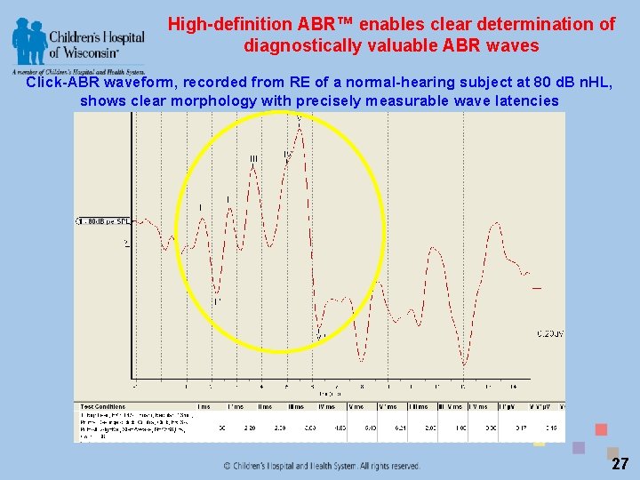 High-definition ABR™ enables clear determination of diagnostically valuable ABR waves Click-ABR waveform, recorded from