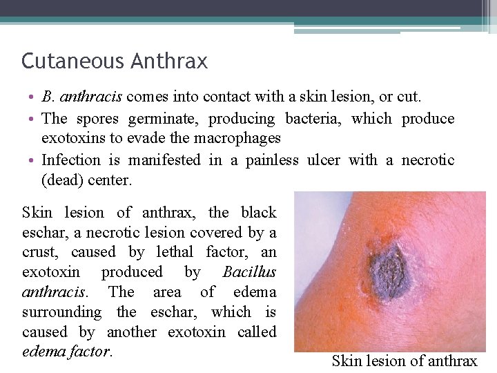 Cutaneous Anthrax • B. anthracis comes into contact with a skin lesion, or cut.