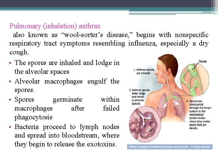 Pulmonary (inhalation) anthrax also known as “wool-sorter’s disease, ” begins with nonspecific respiratory tract