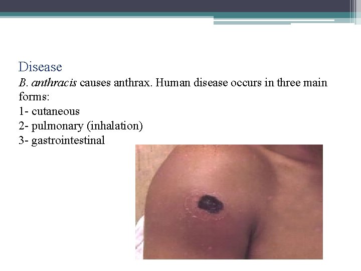 Disease B. anthracis causes anthrax. Human disease occurs in three main forms: 1 - Disease B. anthracis causes anthrax. Human disease occurs in three main forms: 1 -