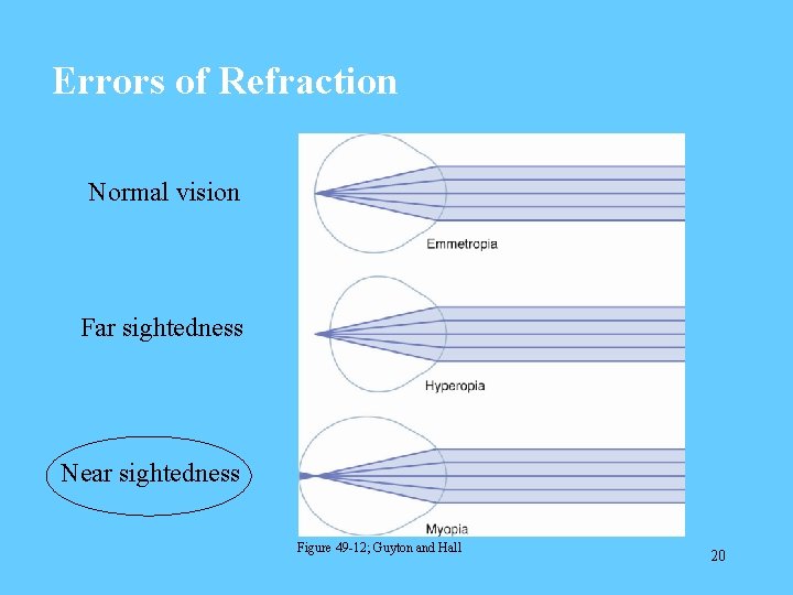 Errors of Refraction Normal vision Far sightedness Near sightedness Figure 49 -12; Guyton and