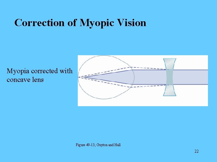 Correction of Myopic Vision Myopia corrected with concave lens Figure 49 -13; Guyton and