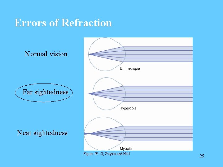 Errors of Refraction Normal vision Far sightedness Near sightedness Figure 49 -12; Guyton and