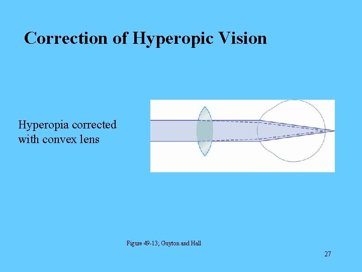 Correction of Hyperopic Vision Hyperopia corrected with convex lens Figure 49 -13; Guyton and