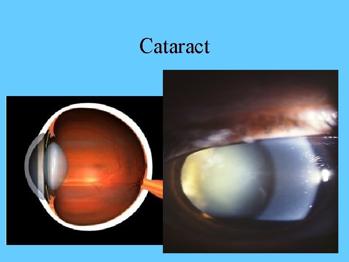 Cataract 34 