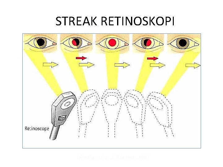 STREAK RETINOSKOPI Dikutip dari A K Khurana, 2007 