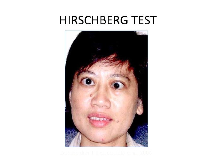 HIRSCHBERG TEST Dikutip dari T Schlote, MD et al, 2006 