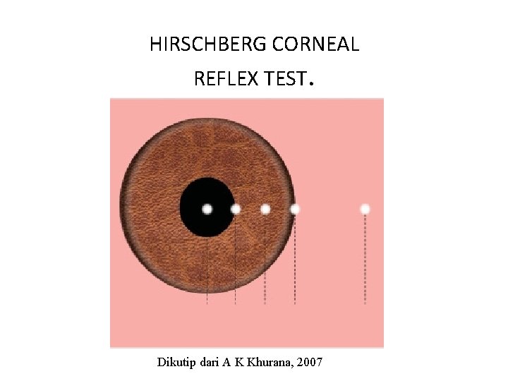 HIRSCHBERG CORNEAL REFLEX TEST. Dikutip dari A K Khurana, 2007 