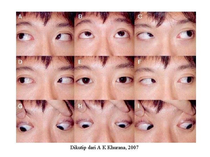 Dikutip dari A K Khurana, 2007 