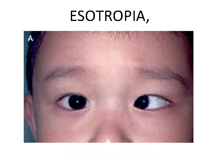 ESOTROPIA, Dikutip dari T Schlote, MD et al, 2006 