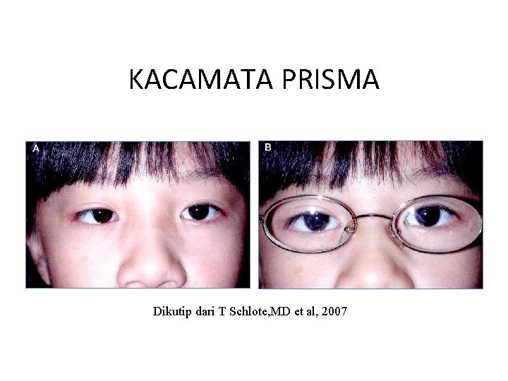 KACAMATA PRISMA Dikutip dari T Schlote, MD et al, 2007 