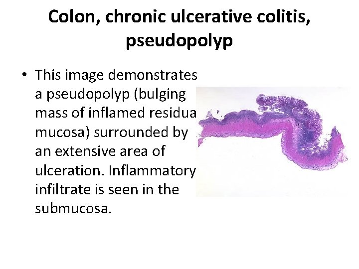 Colon, chronic ulcerative colitis, pseudopolyp • This image demonstrates a pseudopolyp (bulging mass of