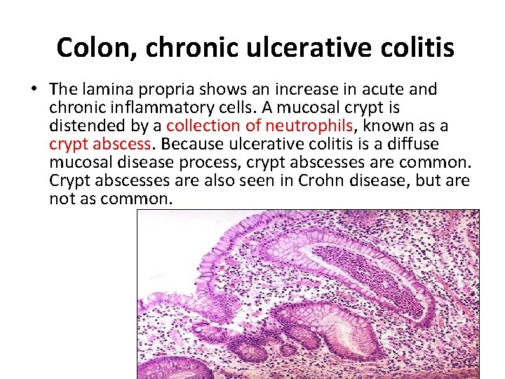  Colon, chronic ulcerative colitis • The lamina propria shows an increase in acute