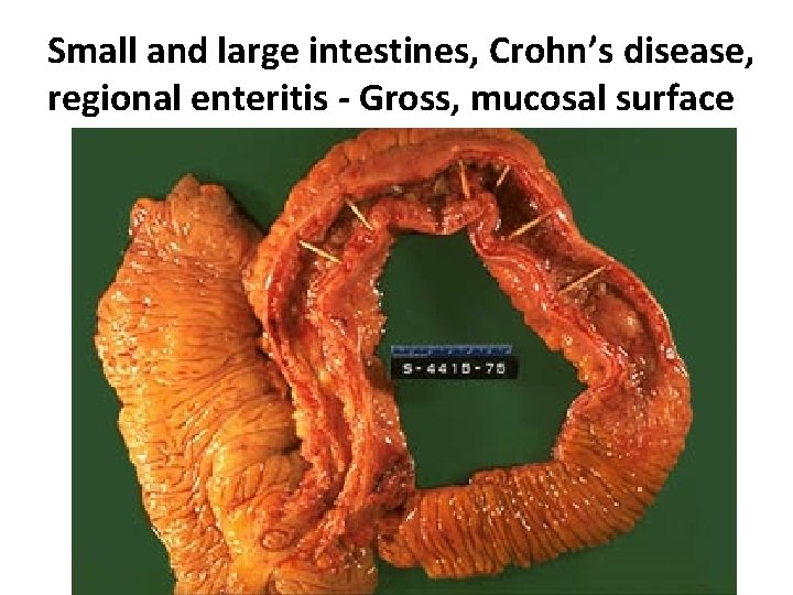 Small and large intestines, Crohn’s disease, regional enteritis - Gross, mucosal surface 