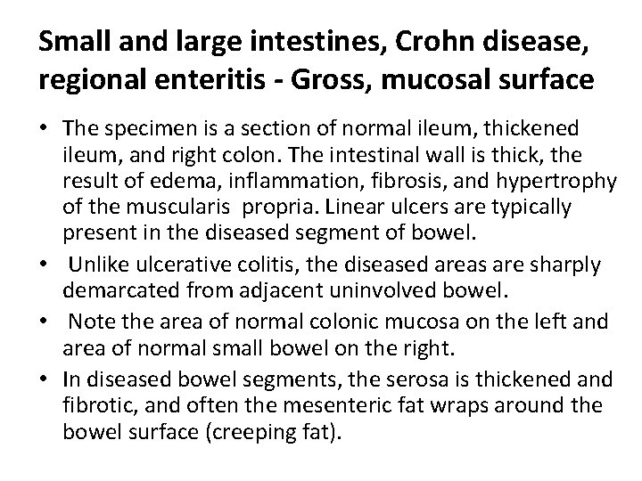 Small and large intestines, Crohn disease, regional enteritis - Gross, mucosal surface • The