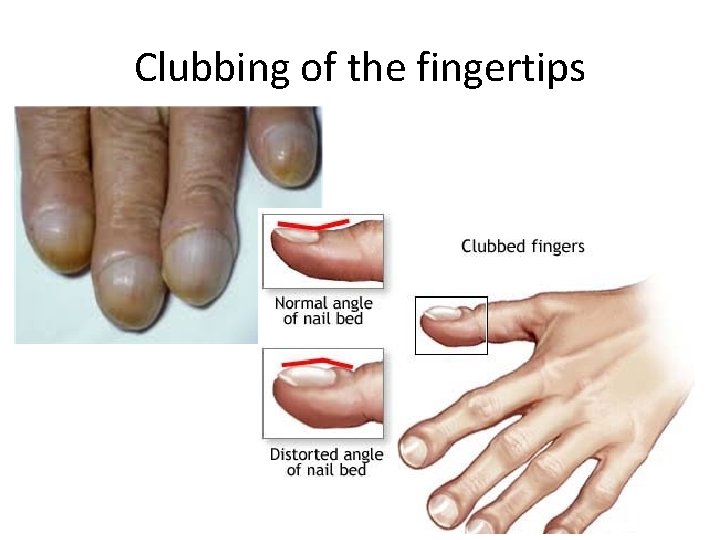 Clubbing of the fingertips 