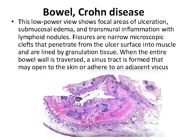 Bowel, Crohn disease • This low-power view shows focal areas of ulceration, submucosal edema,