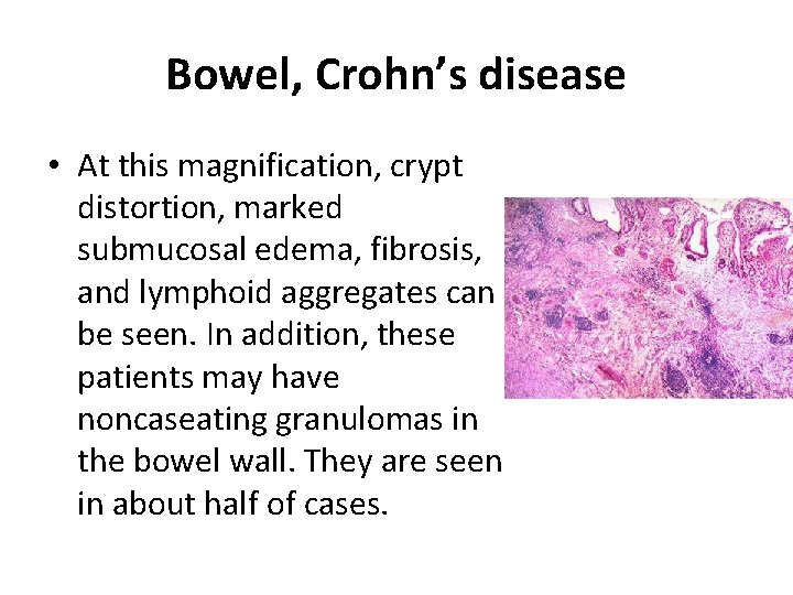 Bowel, Crohn’s disease • At this magnification, crypt distortion, marked submucosal edema, fibrosis, and