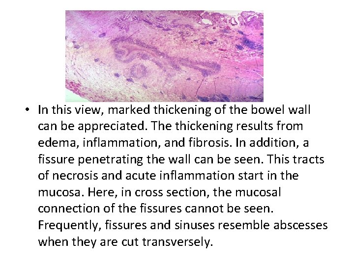  • In this view, marked thickening of the bowel wall can be appreciated.