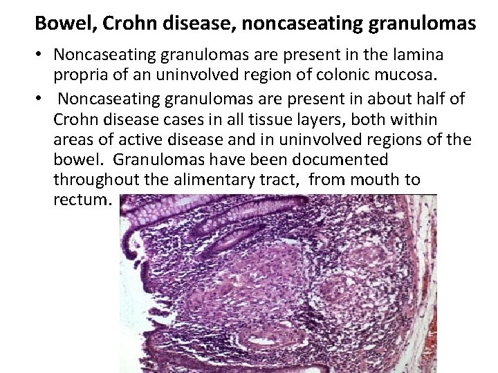 Bowel, Crohn disease, noncaseating granulomas • Noncaseating granulomas are present in the lamina propria