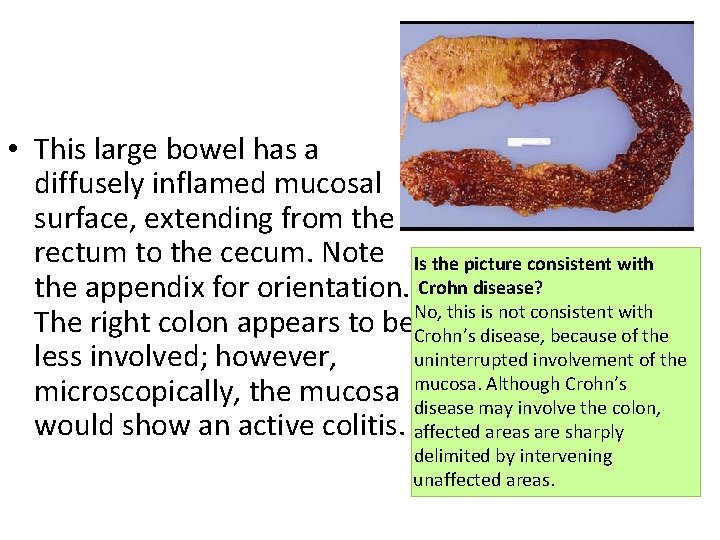  • This large bowel has a diffusely inflamed mucosal surface, extending from the