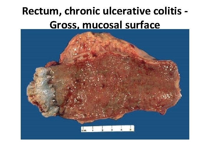 Rectum, chronic ulcerative colitis - Gross, mucosal surface 