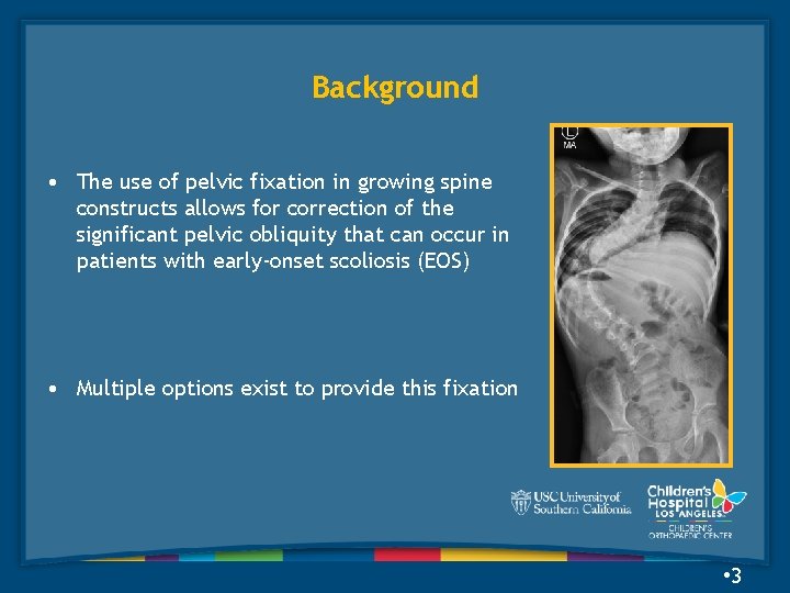 Background • The use of pelvic fixation in growing spine constructs allows for correction