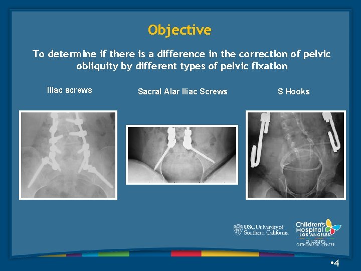 Objective To determine if there is a difference in the correction of pelvic obliquity