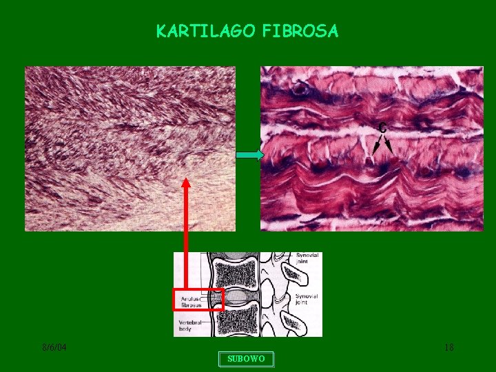 KARTILAGO FIBROSA 8/6/04 18 SUBOWO 