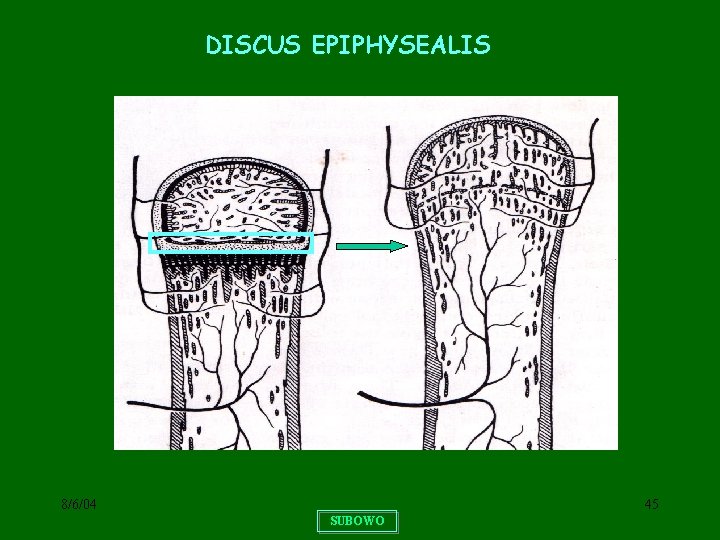 DISCUS EPIPHYSEALIS 8/6/04 45 SUBOWO 