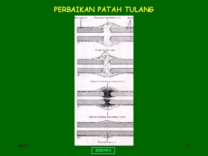 PERBAIKAN PATAH TULANG 8/6/04 50 SUBOWO 