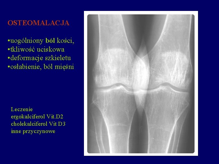 OSTEOMALACJA • uogólniony ból kości, • tkliwość uciskowa • deformacje szkieletu • osłabienie, ból